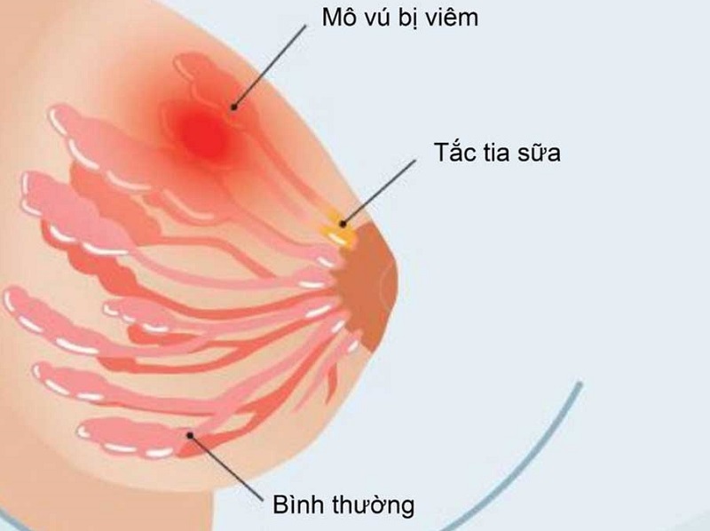 Tắc tia sữa là gì?