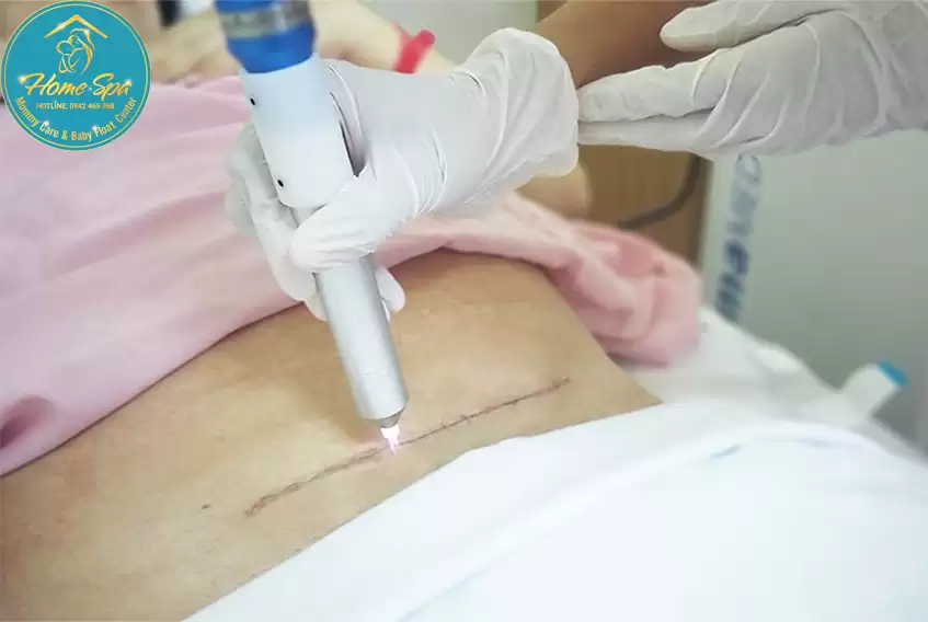 Chiếu tia Plasma mẹ sau sinh